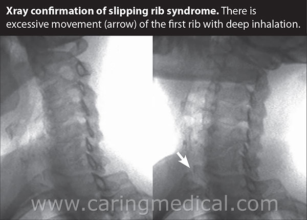 clicking rib syndrome